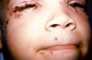 little kid with herpes
